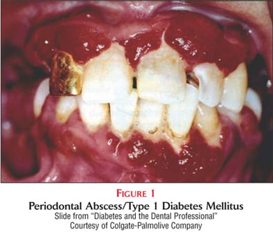 Periodonal Abscess/Type 1 Diabetes Mellitus