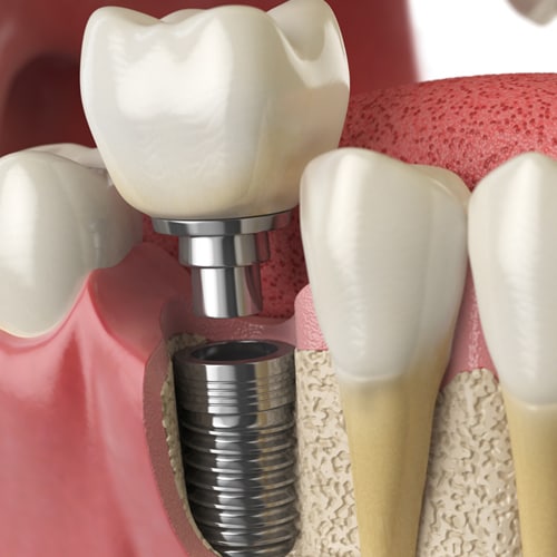  anatomy-healthy-teeth-tooth-dental-implant