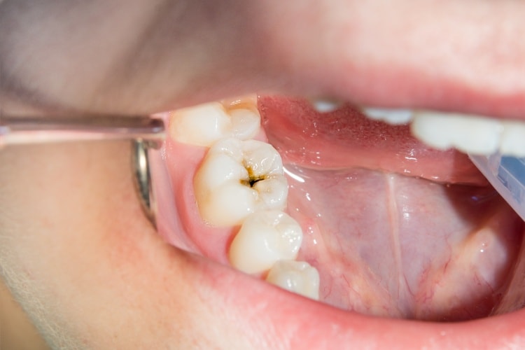 close-human-rotten-carious-tooth-treatment