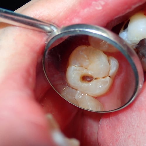  dental-tooth-decay-cavity-found-during