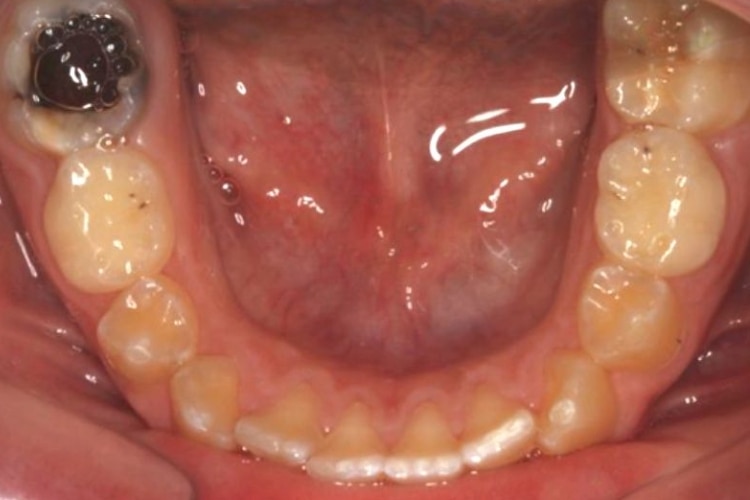 Hypomin-decay-b