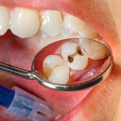 Mouth and teeth patient with Initial Preparation of Carious Maxillary Premolar