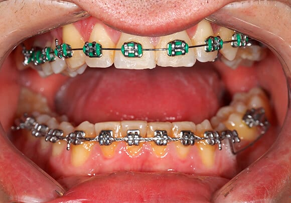 Braces in Mouth Biofilm On Orthodontic Patient