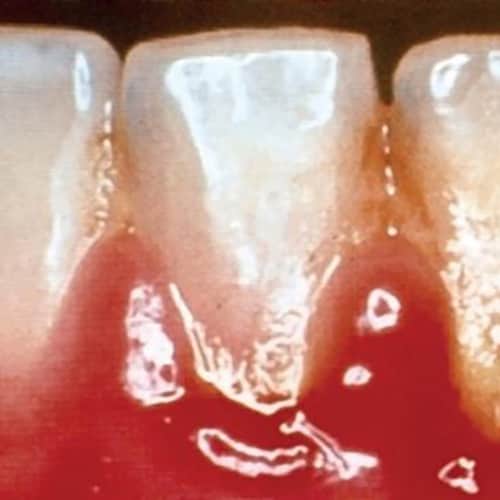 Localized Gingival Inflammation