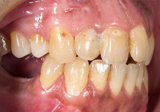 Dental caries and plaque image of teeth