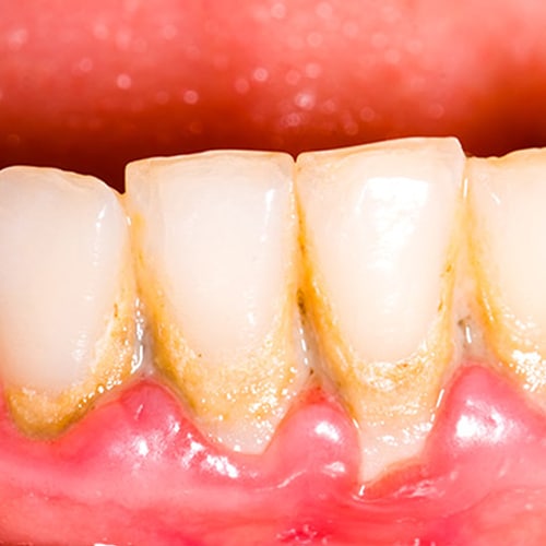 Gingival Inflammation, Heavy Biofilm, Superation