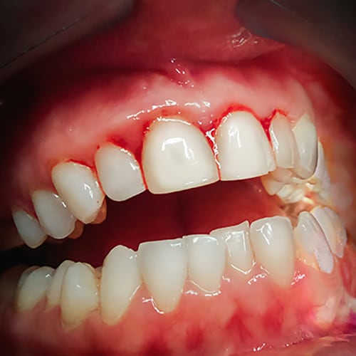 Image of bleeding gums; Periodontitis; Pocketing And Bleeding On Probing