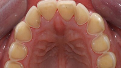 Close up of teeth with signs of erosion